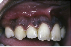 <ul><li><p>Serious, pain that prevents normal chewing</p></li><li><p>Halitosis</p></li><li><p><strong>Prevotella intermedia</strong> (primary)</p></li></ul>