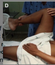 <p><span>is a clinical sign of acute appendicitis, it is defined as&nbsp;</span><strong>discomfort felt by the subject/patient on the slow flexion &amp; internal rotation of the hip joint, while the right knee is flexed</strong><span>. It indicates an inflamed pelvic appendix that is in contact with the obturator internus muscle</span></p>