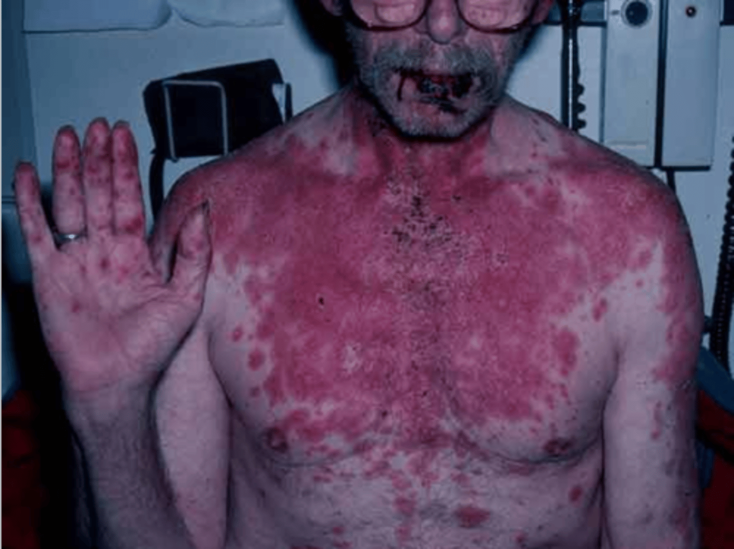 <p>Stevens-Johnson syndrome</p>