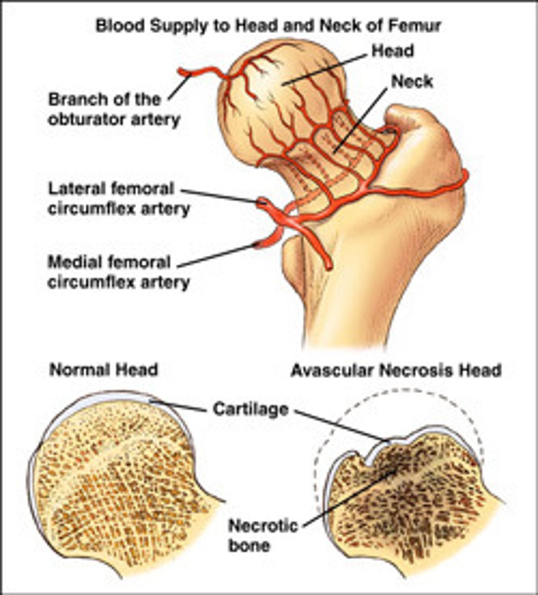 <p>What is it?</p><p>- infarction of bone and marrow</p><p>- usually very PAINFUL</p><p>Where is the most common site of occurrence?</p><p>- most common site is the FEMORAL HEAD (watershed zone between the branch of the obturator and the medial femoral circumflex artery)</p><p>- fractures of the femoral head (common in the elderly with osteoporosis who have sustained a fall) lead to increased osteonecrosis risk due to shearing of the branches of the medial circumflex artery!</p><p>What are the causes?</p><p>- CAST Bent LEGS</p><p>C: corticosteroids</p><p>A: alcoholism</p><p>S: sickle cell disease</p><p>T: trauma</p><p>B: the Bends (caisson/decompression disease)</p><p>LE: LEgg-Calve-Perthes disease (idiopathic)</p><p>G: gaucher disease</p><p>S: slipped capital femoral epiphysis</p>