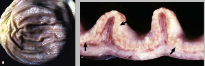 <p>What is this condition caused by? Describe the pathogenesis. </p>