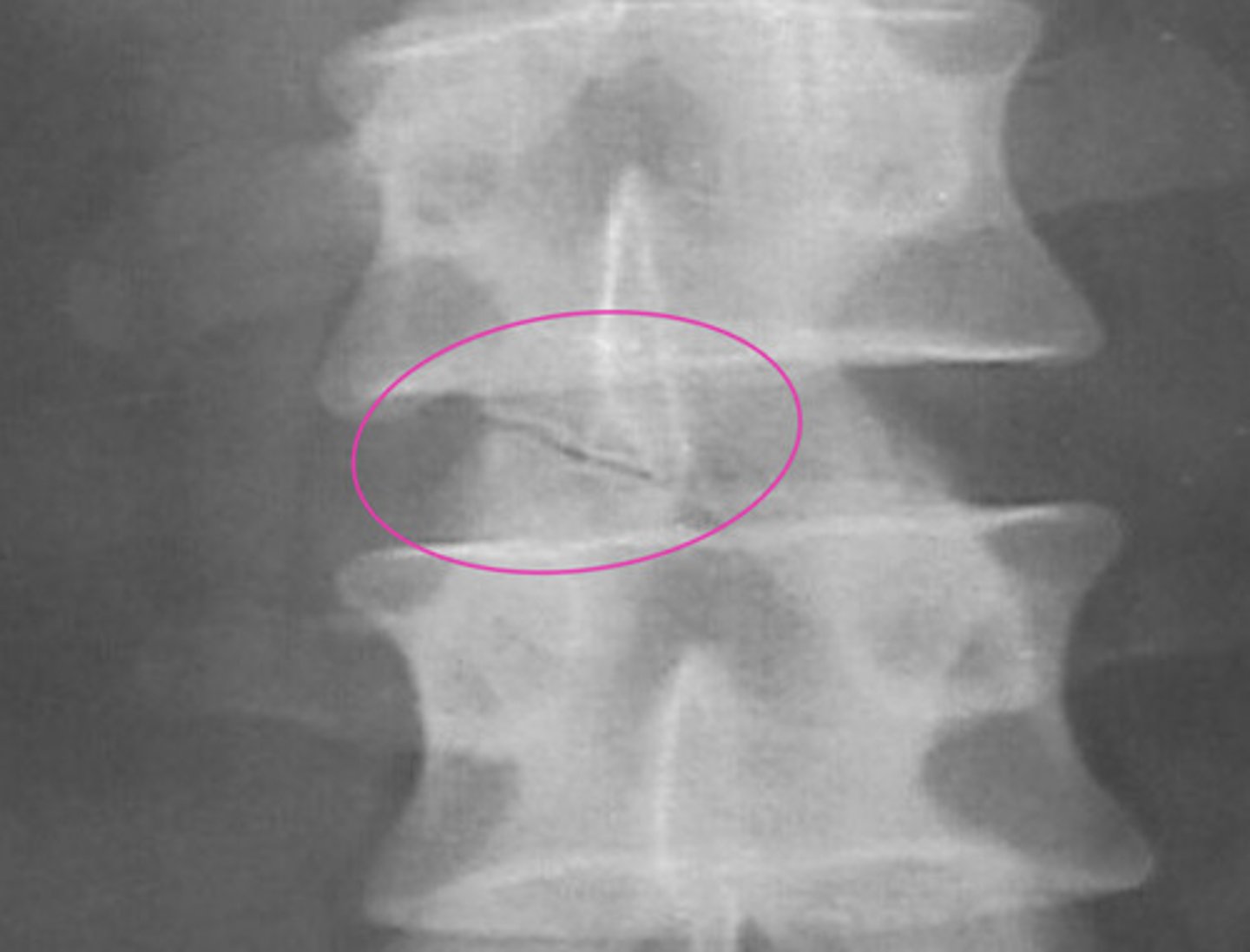 <p>Thought to arise as a result of the non-union of an articular process secondary ossification center (typically fuses between ages 17 and 25)</p>