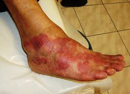 <p><span>The result of the immune system reacting to unwanted stimulation. It shows as swelling, pain, tenderness, redness and/or heat. Immune system cells are seen in the specimen being examined. These inflammatory cells include 1) neutrophils, which are the white blood cells that make up pus and are seen in acute or early inflammations, 2) lymphocytes, which are typically seen in more chronic or longstanding inflammations, and 3) macrophages (histiocytes), which are also seen in chronic inflammation. Some types of inflammation are readily diagnosable such as an infected skin wound, others require a biopsy to show the cause and prove they are not NEOPLASMS. The suffix "-itis" is appended to a root word to indicate "inflammation of".</span></p>