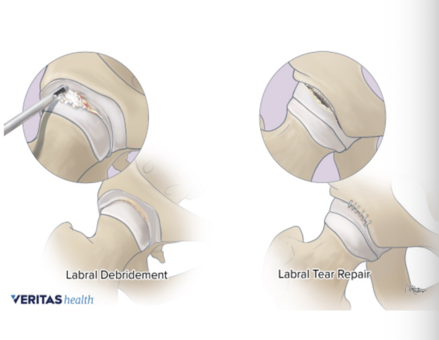 <p>Labral Tear Treatment</p>