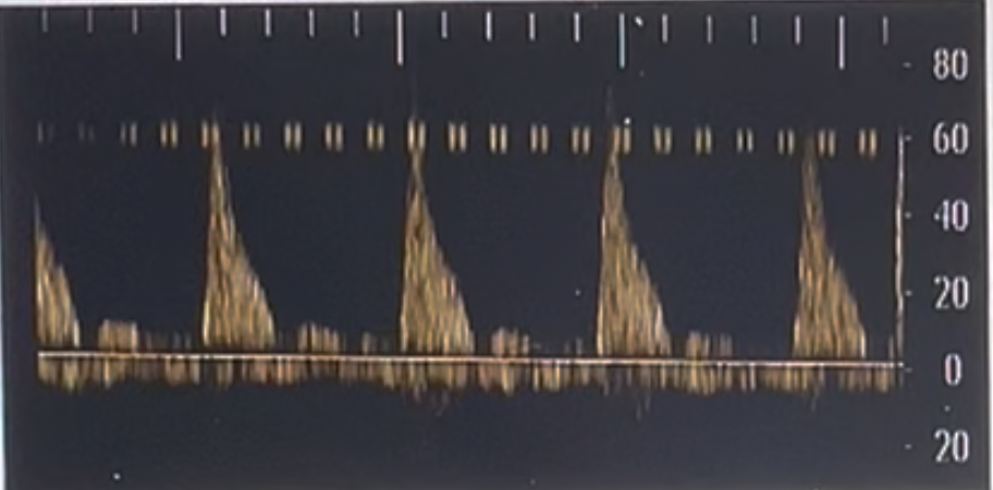 <p>What acoustic artifacts is noted on the Doppler tracing?</p><p>a. misregistration<br>b. clutter <br>c. range ambiguity <br>d. electrical interference</p>