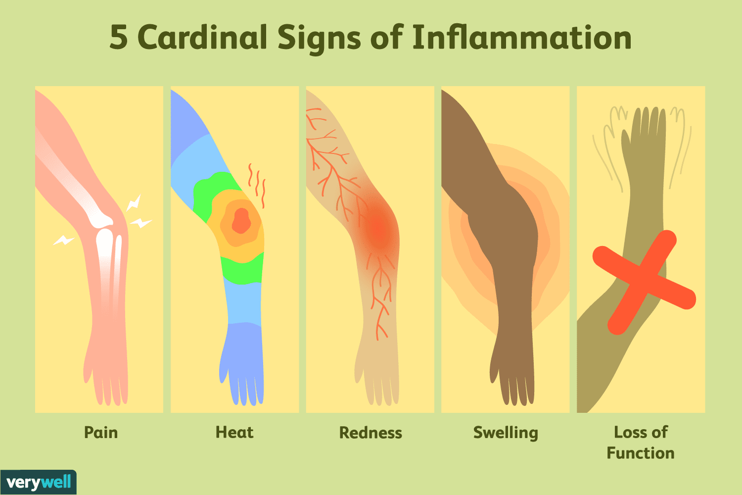<p><span style="font-family: &quot;New York&quot;"><strong>5 cardinal signs of inflammation:</strong></span></p><ol><li><p><span style="font-family: &quot;New York&quot;"><strong>Rubor <em>(redness)</em></strong></span></p></li><li><p><span style="font-family: &quot;New York&quot;"><strong>Tumor <em>(swelling)</em></strong></span></p></li><li><p><span style="font-family: &quot;New York&quot;"><strong>Dolar <em>(pain)</em></strong></span></p></li><li><p><span style="font-family: &quot;New York&quot;"><strong>Calor <em>(heat)</em></strong></span></p></li><li><p><span style="font-family: &quot;New York&quot;"><strong>Functio laeso <em>(loss of function)</em></strong></span></p></li></ol><p></p>