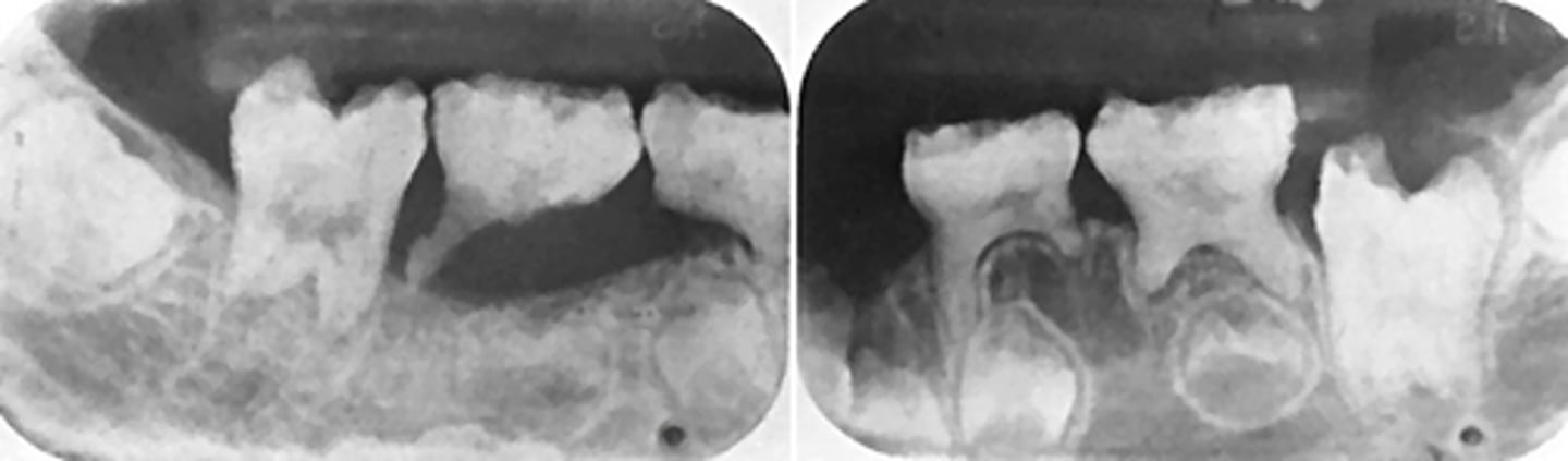 <p>After checking a serum levels you see</p><p>Normal PTH</p><p>Normal Vitamin D</p><p>Low calcium</p><p>What is the diagnosis?</p>