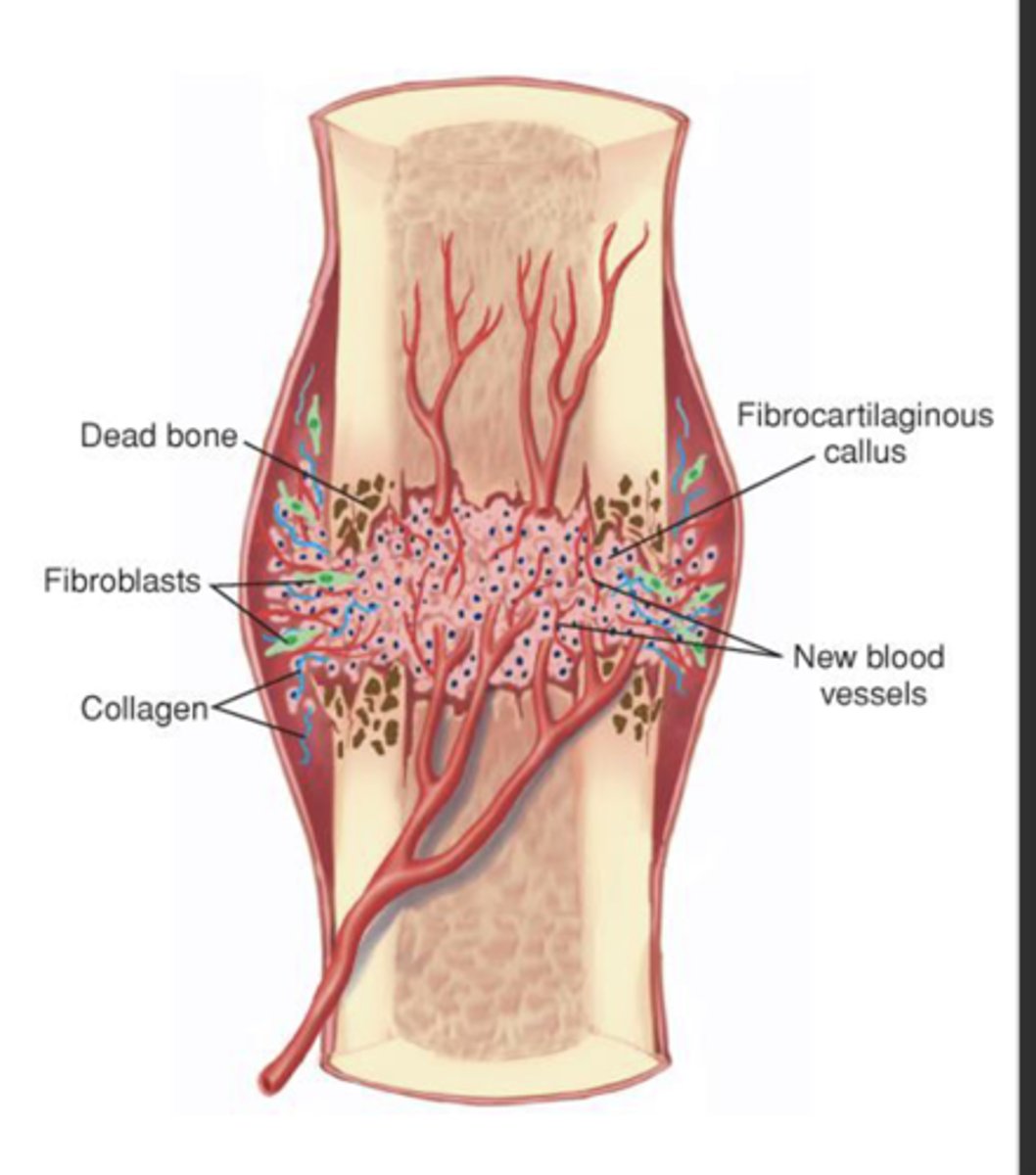 <p>Granulation tissue called procallus is formed</p><p>Fibroblasts invade the procallus</p><p>Fibroblasts produce soft callus bridge that connects bone fragments</p><p>Callus formed by end of 2nd or 3rd week, not strong enough for weight bearing</p>