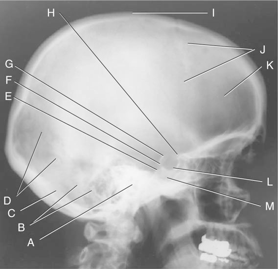 <p>Lateral skull: the structure H is the:</p><p>a. Sella turcica</p><p>b. Dorsum Sellae</p><p>c. anterior clinoid process</p><p>d. occipital bone</p>