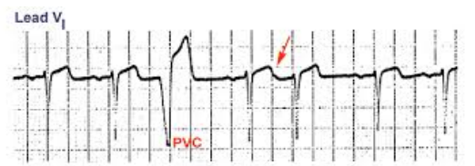 <p>-Ectopic beats characterized by an extra p wave</p><p>-Can be hidden within the waves, making it hard to see</p>