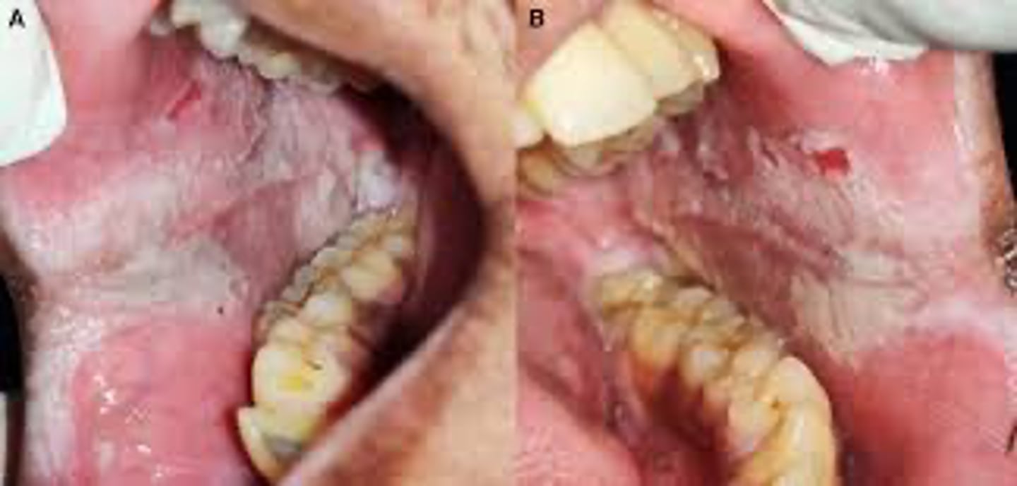 <p>A young patient presents with diffuse, thick, bilateral white plaques on the buccal mucosa. The lesions are asymptomatic and there is a family history of similar findings.</p><p>What is the most likely diagnosis?</p>