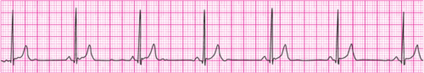 <p>Sinus bradycardia</p>
