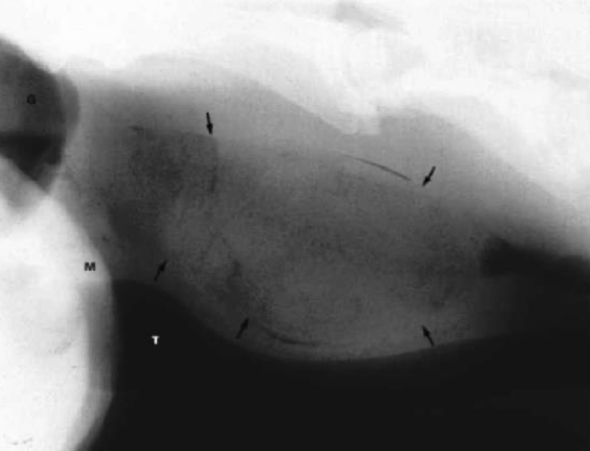 <p>Food becomes lodged in the esophagus, causing obstruction and discomfort leads to ptyalism, dysphagia, coughing, regurge of food, water and saliva from mouth and nostrils</p><ul><li><p>odynohphagis → painful swallowing </p></li><li><p>repeated extension of the head and neck </p></li><li><p>distress, agitation </p></li><li><p>can lead to anorexia, electrolyte imbalance, dehydration, aspiration pneumonia (clinical signs occur 1 day after the choke) </p></li></ul><p></p>