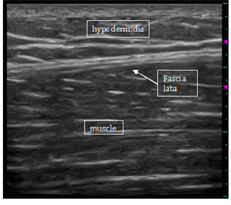 <p>Thin, hyperechoic (bright) structure</p>