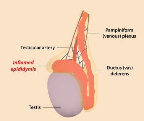 <p>= indurated, swollen and tender epididymis</p><ul><li><p>severe pain relieved by elevation</p></li></ul>