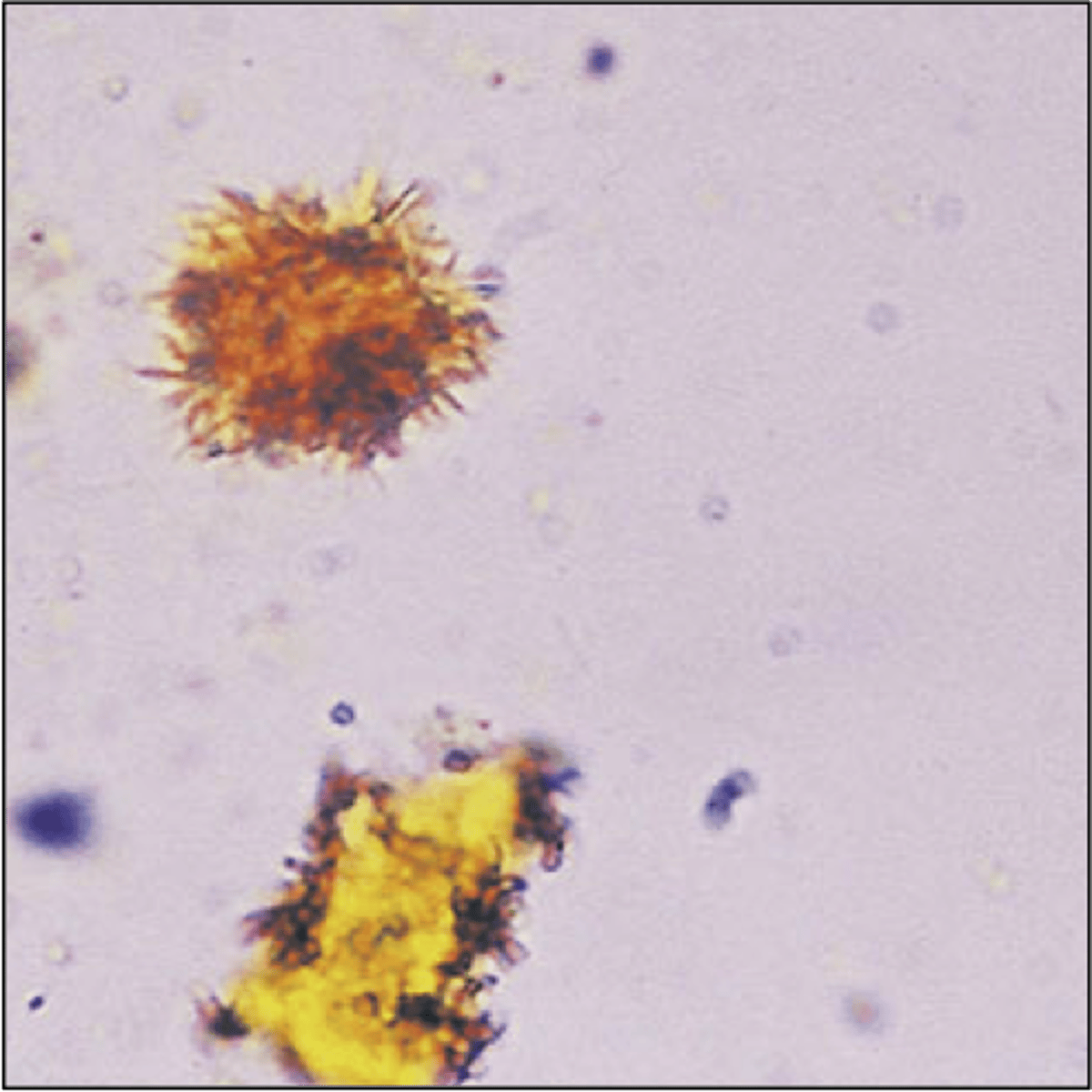 <p>present in hepatic disorders (Viral Hepatitis) producing large amounts of bilirubin in the urine<br><br>Color: Yellow<br><br>Clumped needles or granules</p>