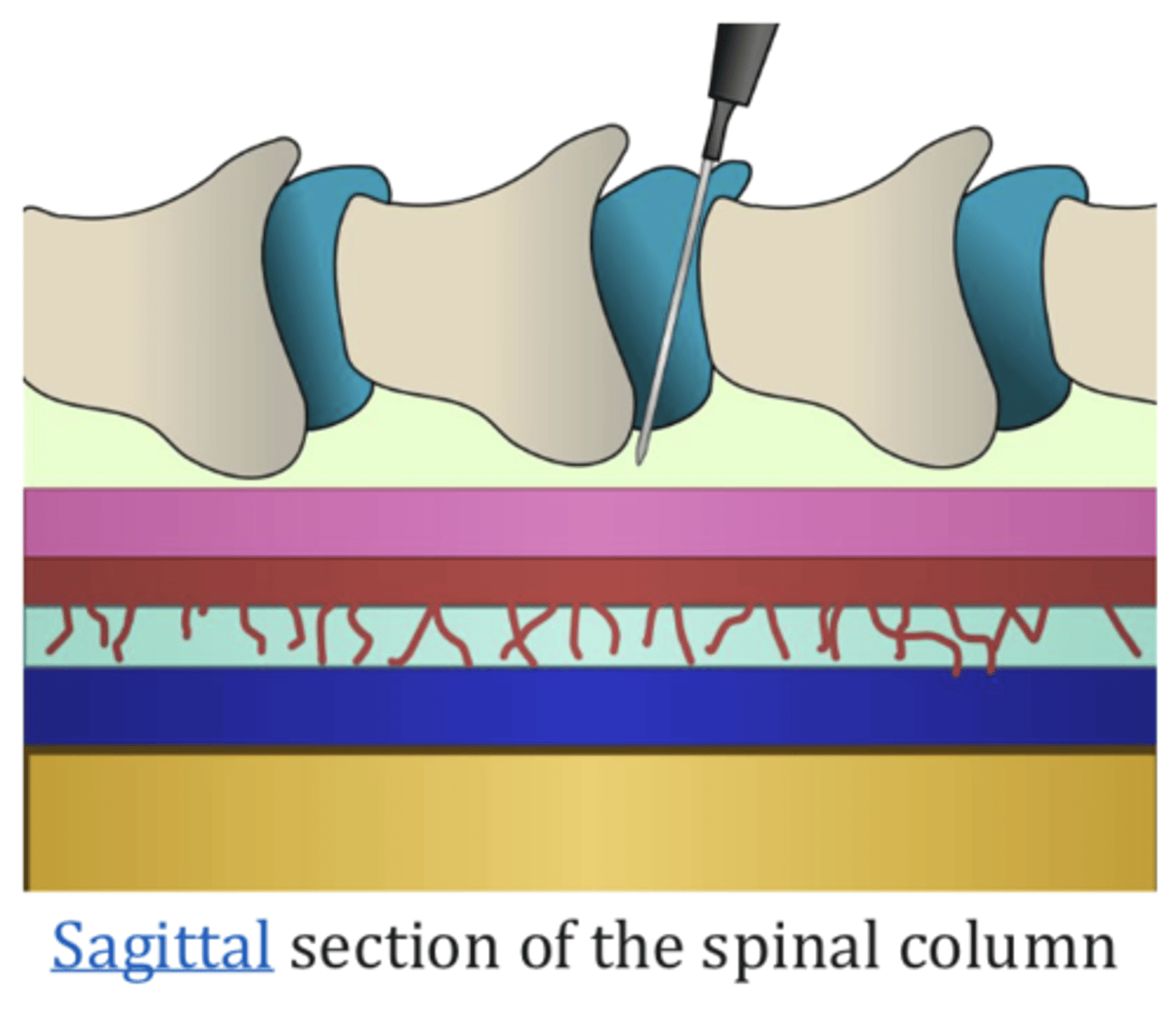 <p>- outside of the dura and not into the cerebrospinal fluid</p><p>- localized to spinal cord</p><p>(morphine sulfate extended, steroids, anesthetics)</p>