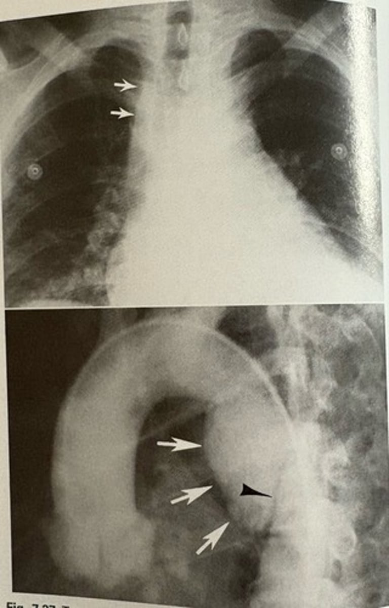 <p>what pathology is present?</p>