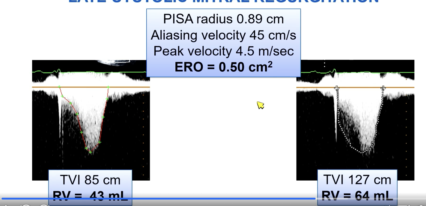 <p>Pitfalls of PISA quantification of MR.</p><p>One of which is if there is late systolic MR where you have a large jet on color doppler.</p><p>Which of the pictures more accurately outlines the jet for an appropriate VTI?</p><p></p>