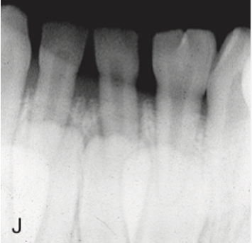 <ul><li><p>occurs as the single tooth germ tries unsuccessfully to divide into two tooth germs, resulting in a notably large, single-rooted tooth with common pulp cavity</p></li><li><p>developmental disturbance during cap stage</p></li><li><p>gemini (two heads, two germs)</p></li><li><p>root is one but the head is two</p></li><li><p>normal number of teeth</p></li></ul><p></p>