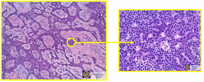<p>ÉPULI (perro)&nbsp;</p><ul><li><p>fibroma odontogénico periférico (fibromatoso o osificante)&nbsp;</p></li><li><p>ameloblastoma acantomatoso&nbsp;</p></li></ul><p></p>