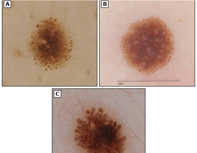 <p>what lesion has this appearance under a dermatoscope?</p><ul><li><p>starburst / globular pattern of pigment</p></li><li><p>prominent punctate or rounded blood vessels</p></li><li><p>regularly distributed dottiest vascular pattern</p></li></ul><p></p>