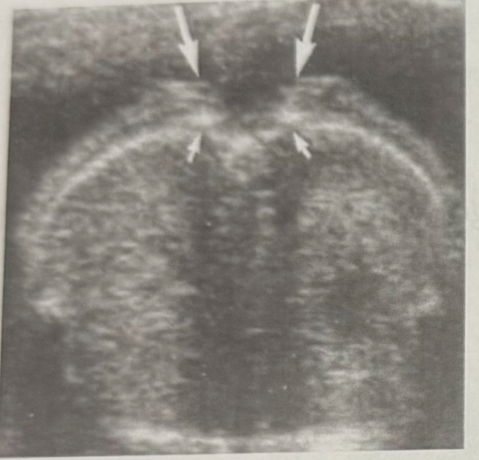 <p>What is the section and what is shown?</p><p>a. Sagittal spine</p><p>b. Transverse spine</p><p>c. Coronal spine</p>