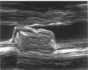 <p>decreased E/F slope </p>