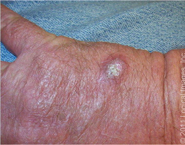 <p><strong>malignant cutaneous tumor arising from epidermal keratinocytes</strong></p><p>caused by DNA mutations from UV exposure, smoking, aging, and immune suppression</p>