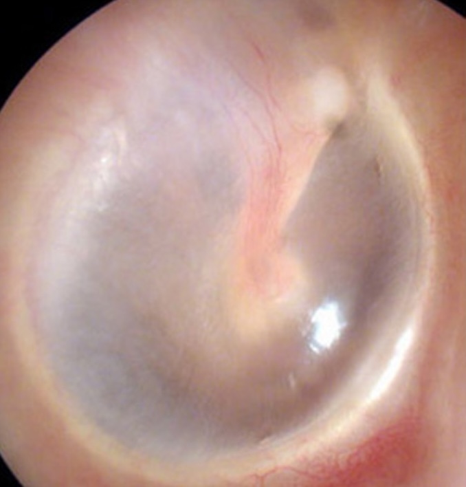 <p>A healthy tympanic membrane (eardrum) is pearly white or gray in color, but you can see through it. <br>Reflection<br>- Left: 7 o'clock<br>- Right: 5 o'clock</p>
