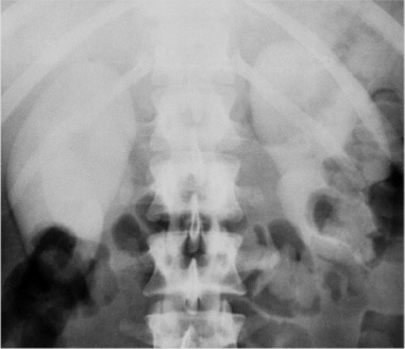 <p>- What is the rapid and severe deterioration of kidney function caused by necrosis due to ischemia and toxic injury?</p><p>- What is the imaging modality of choice to evaluate the kidneys?</p><p>- What radiographic exam will show bilateral renal enlargement and a prolonged nephron state?</p>