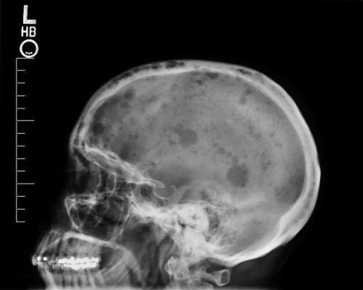 <p>•Fatigue, due to anemia</p><p>•Excessive thirst/urination, due to excess calcium</p><p>•Nausea, due to excess calcium</p><p>•Bone pain/back and ribs, due to plasma cell acceleration</p><p>•Bone fractures, due to calcium leaching from bones into circulation. Punched out lesions on X ray.</p><p>•Unexpected infections, due to compromised immunity</p><p>•Weakness and numbness in the legs, due to vertebrae compression.</p>