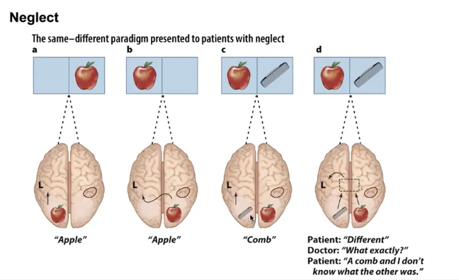 <ul><li><p>e.g. When <strong>right hemisphere is damaged</strong>, object can only be identified in left vf if not competing w/ a stimulus in other field</p></li><li><p>e.g. right hem damage- present cat in left vf, then either dog or carrot in right vf, response time faster w/ dog because patient can just say “animal” instead of “vegetable”</p></li></ul><p></p>