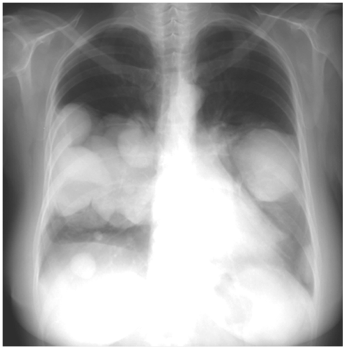 <p>Osteosarcoma lung metastasis</p>