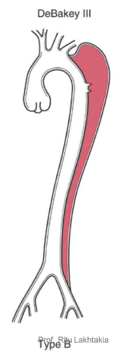 <p>involves descending aorta</p>
