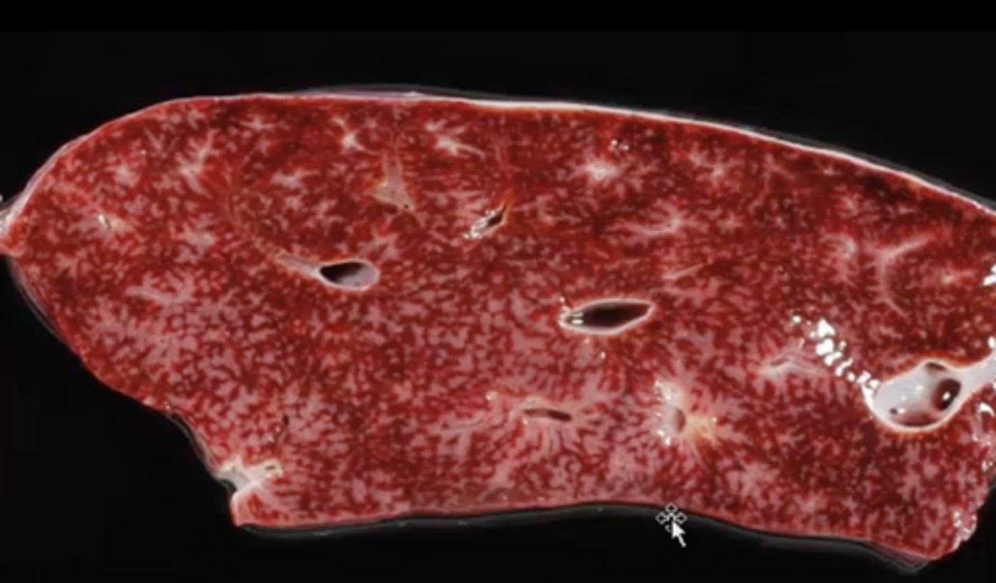 <p>What has caused this gross appearance of this liver?</p>