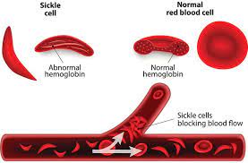 <p>What is Sickle cell disease ?</p>