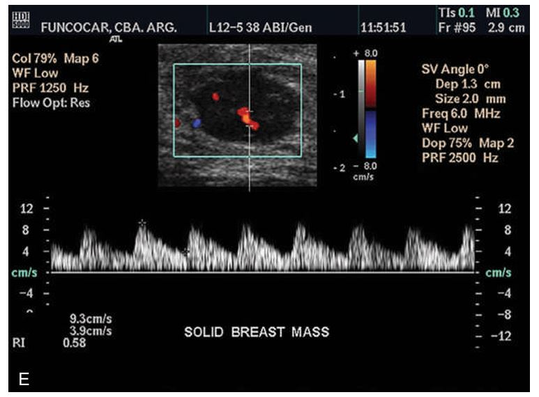 <p>malignant masses often demonstrate ________ vascularity within the lesion and often have a feeder vessel</p>