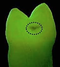 <p>A diagnostic method that uses light to detect dental caries and assess enamel changes by measuring the amount of light reflected from tooth surfaces, decay appears DARK</p>
