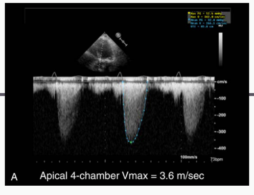 <p>Antegrade systolic</p><p>velocity across the AV</p><p>• HIGHEST CW Doppler</p><p>jet</p>