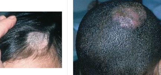 <p>Round scaling patches of alopecia, broken hairs or corkscrew hairs visible on dermoscopy, may be boggy on palpation</p>