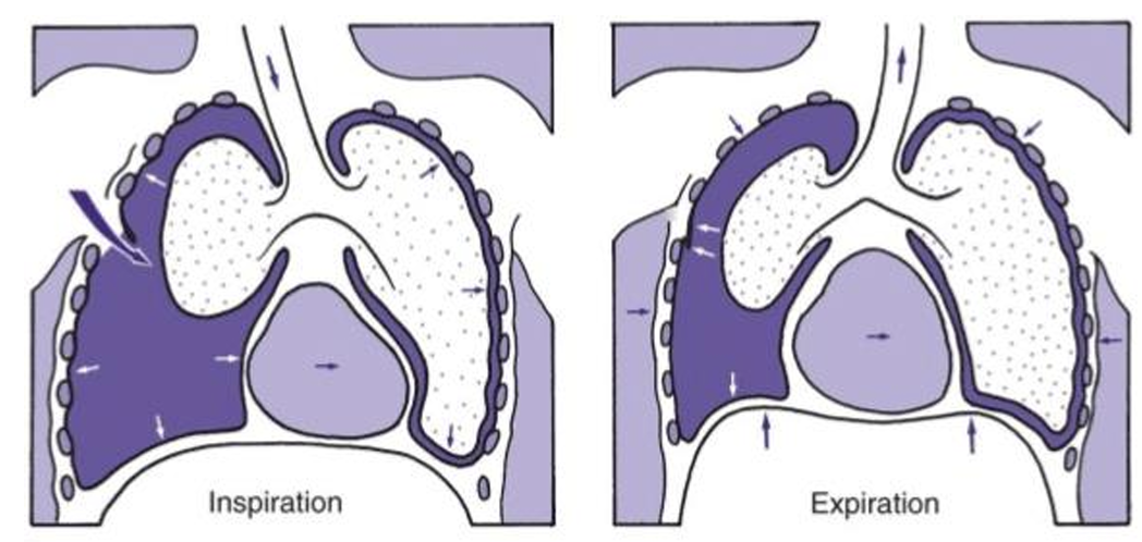 <p>A <strong>tension pneumothorax</strong> occurs when air enters the pleural space during inspiration but <strong>cannot escape during expiration</strong>, leading to <strong>progressive pressure build-up</strong>. </p><p>This pressure compresses the <strong>lung</strong>, shifts the <strong>mediastinum</strong>, and obstructs <strong>venous return to the heart</strong> → can lead to <strong>cardiac arrest</strong> if untreated.</p>