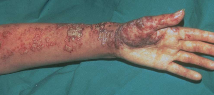 <p>Welke infectie is dit?</p>