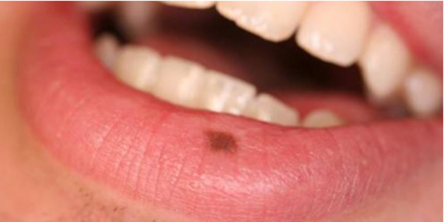 <p>Flat, brown-freckle.</p><p>-Found intraorally or on lip</p><p>-Also known as oral focal melanosis</p><p>-Asymptomatic, no treatment required.</p><p>-Addison's disease-buccal mucosa, gingiva, tongue and lips (petechiae, also on palate)</p>