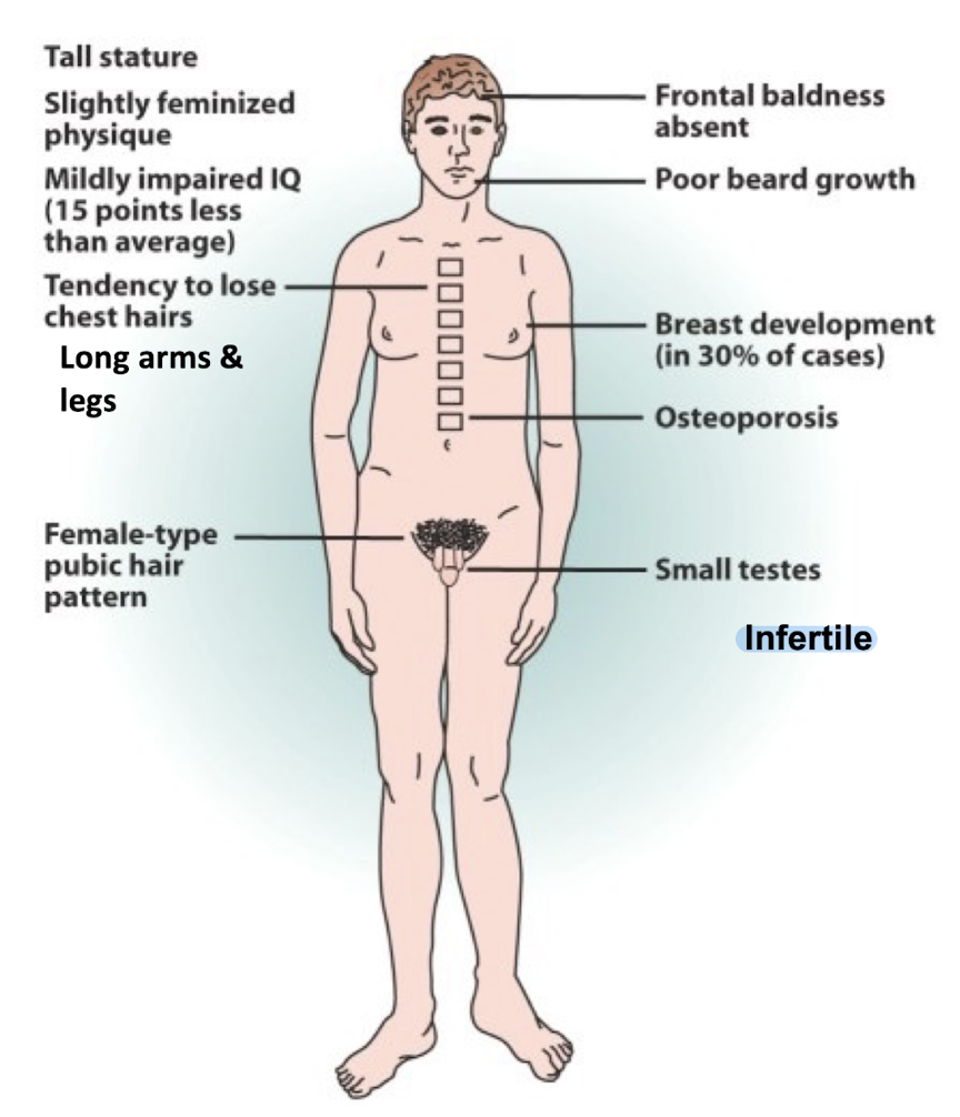 <p>-47, XXY</p><p>-has an extra X </p><p>-Tall stature, slightly feminized physique, osteoporosis, small testies, long arms and legs</p>
