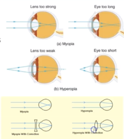 <p>What is Myopia?</p>