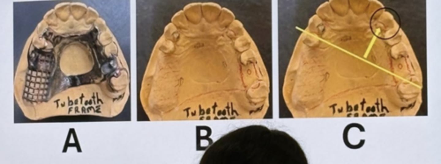 <p>-this is a Kennedy class two model one</p><p>-there are two separate external finish lines and one internal finish line</p><p>-there is a true RPI system on the side, determining the class</p><p>-shows the carving on the maxillary model to seal and prevent food impaction</p>
