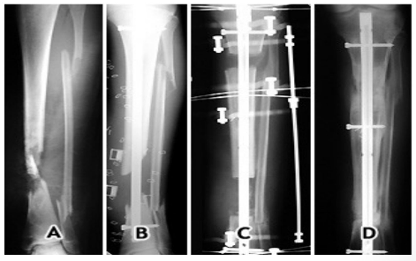 <p>Uses screws, plates, rods, and pins internally to promote immobilization for healing. → May requires additional external support /c external fixation.</p>