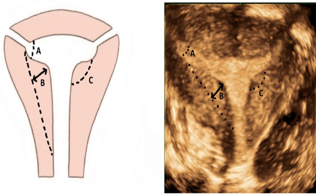 <p>a) maternal exposure to DES</p>