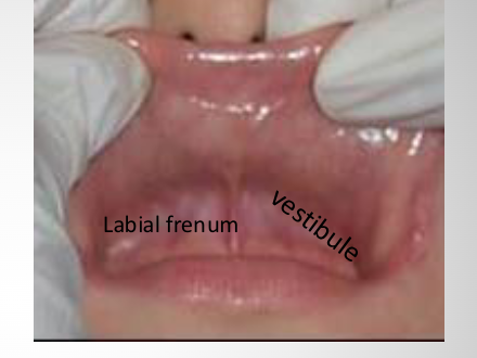 <p><span>the potential space between the teeth, lips and cheeks</span></p>